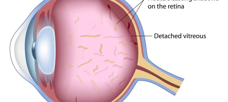 eye floaters headache
