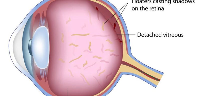eye floaters headache