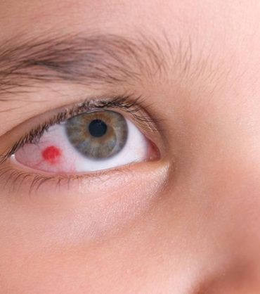 common eye injury decorative image