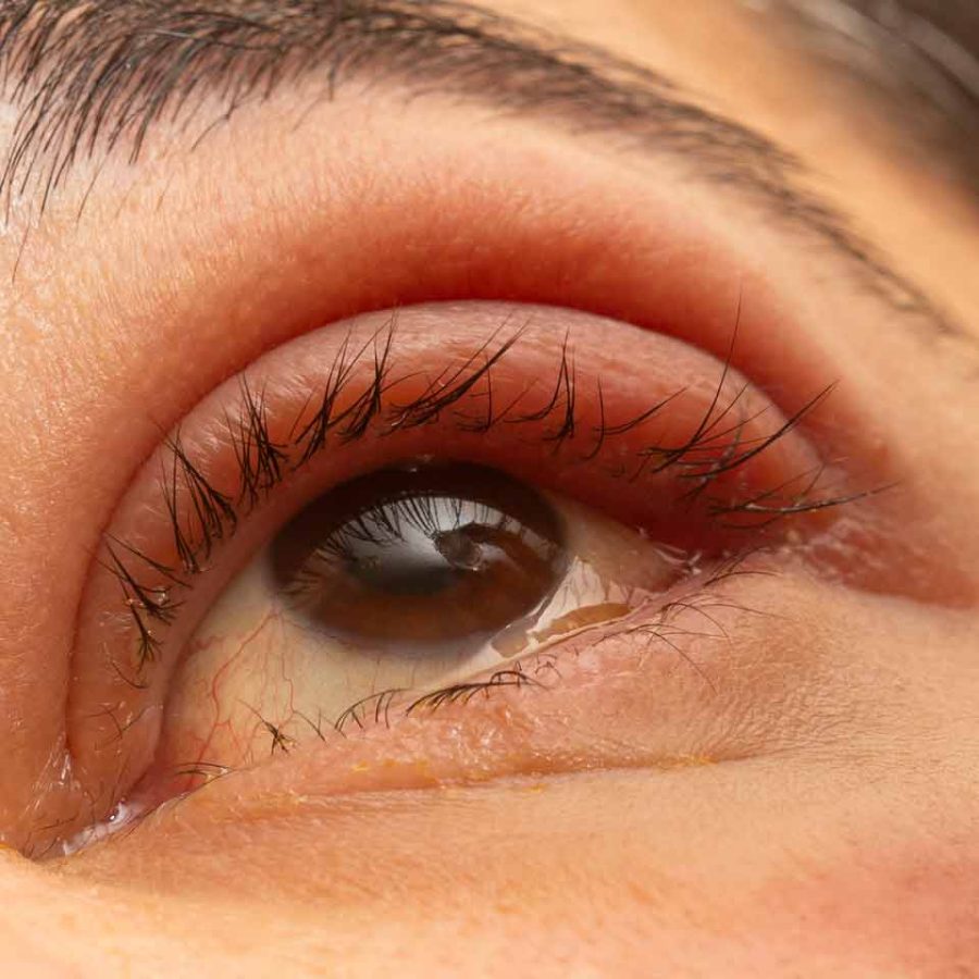dry eye syndrome