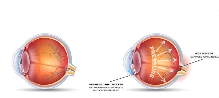 glaucoma symptoms